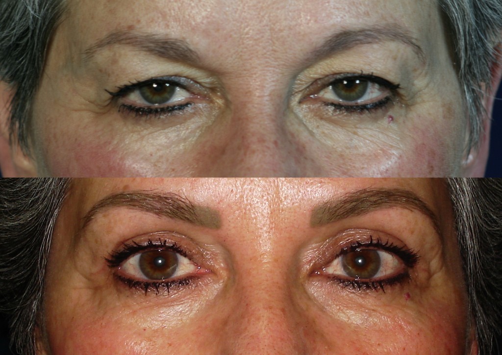 Blefaroplastia